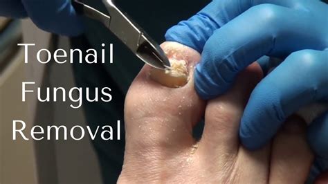 cutting fungus toenails videos